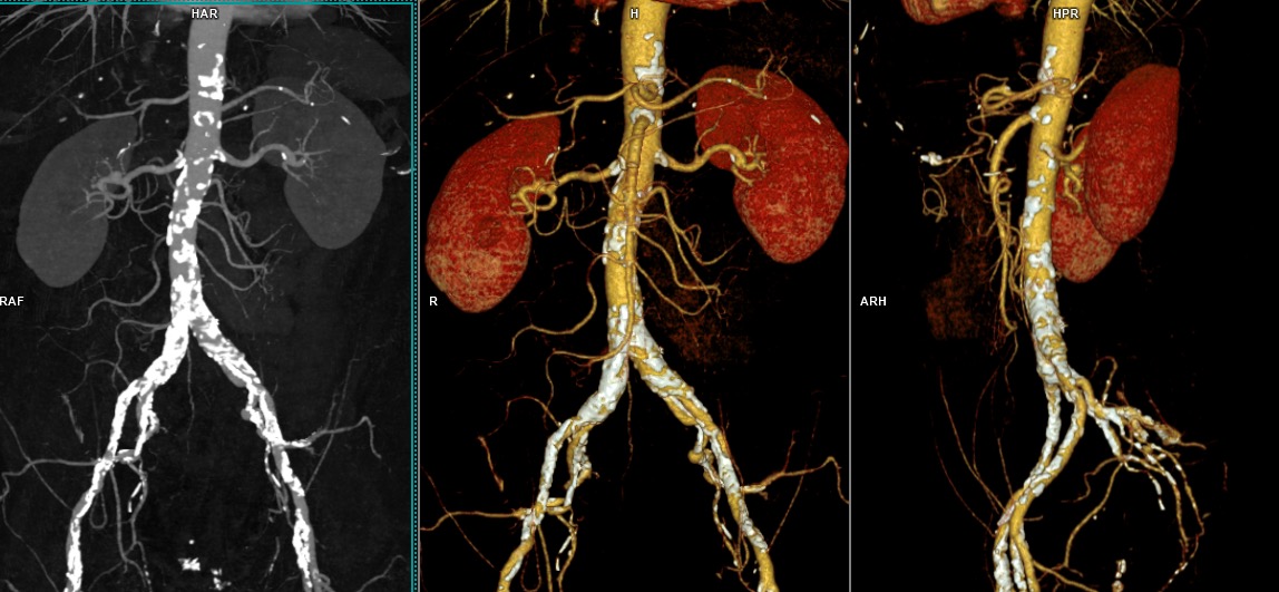 Angioscanner de l'aorte – IMCSM