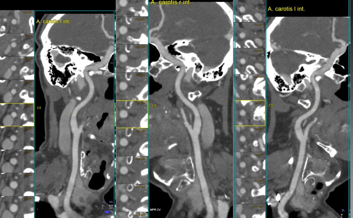 Angioscanner des carotides et troncs supra-aortiques (TSA) – IMCSM