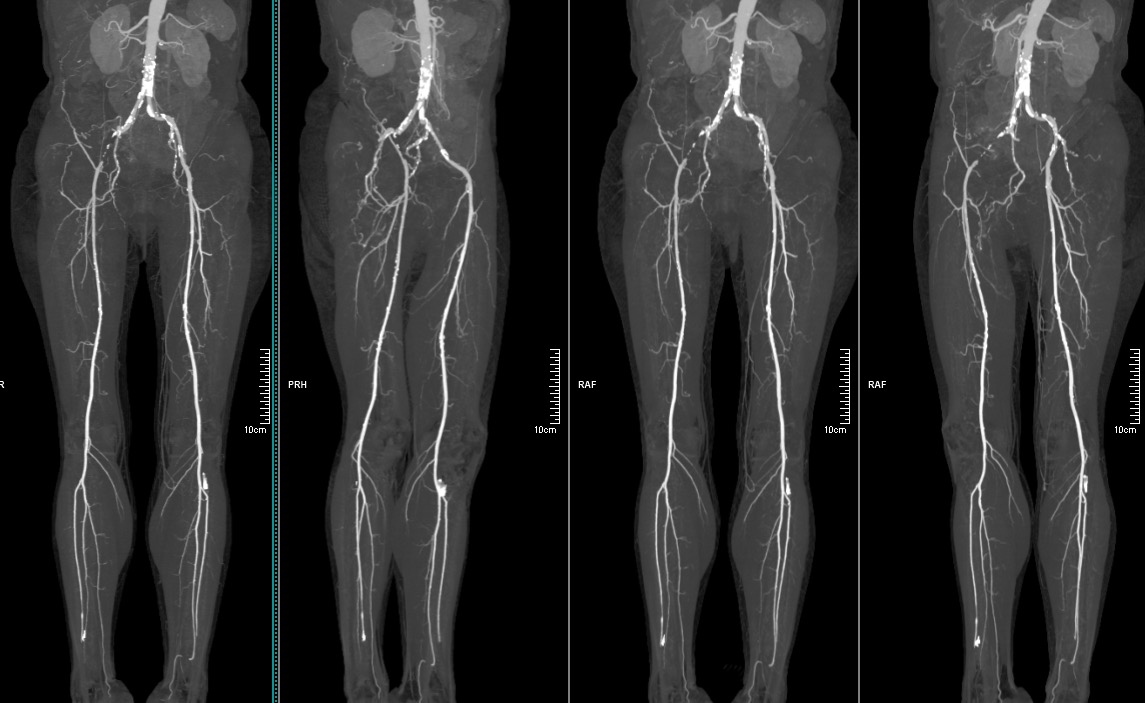 Angioscanner des membres inférieurs – IMCSM