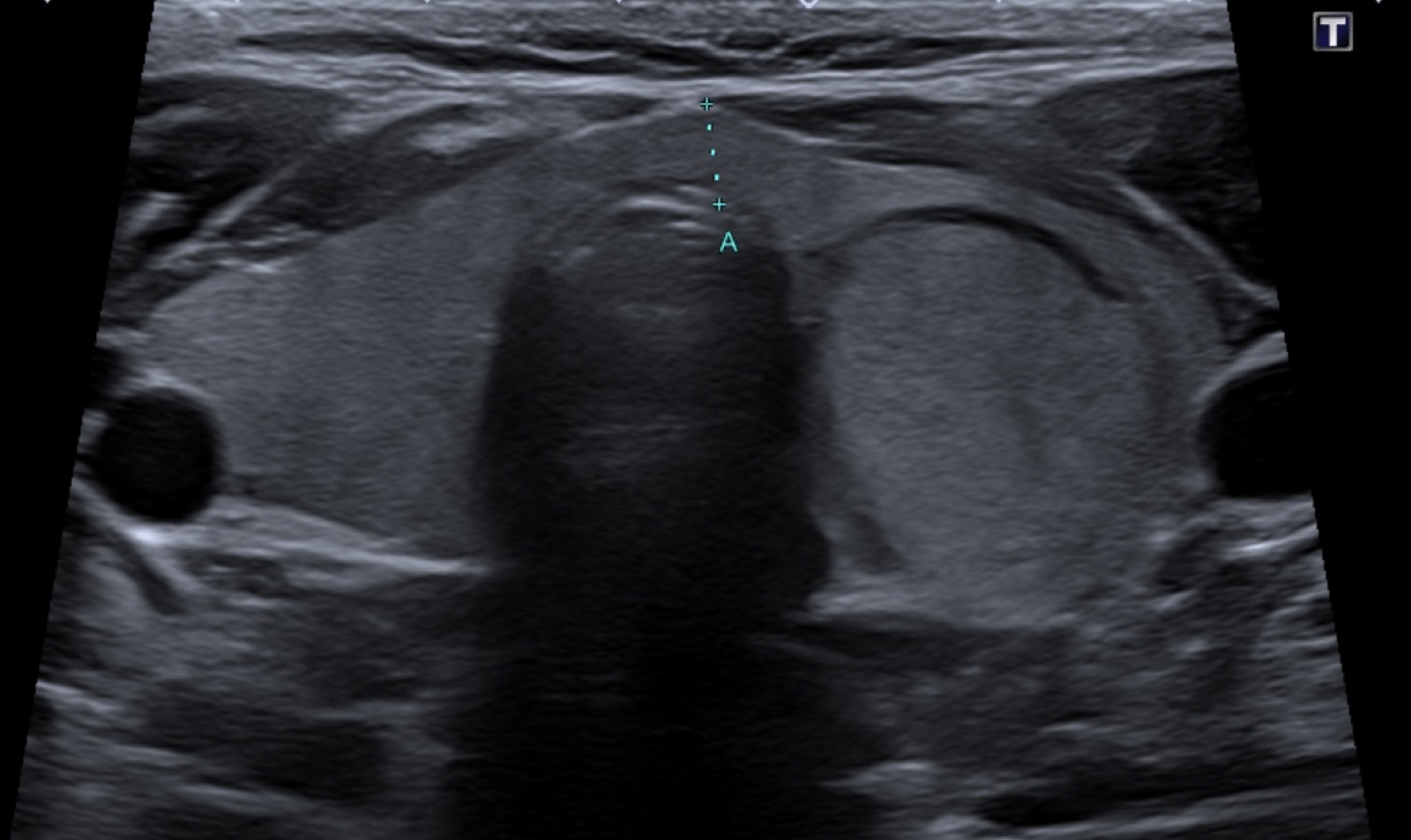 Échographie thyroïdienne – IMCSM