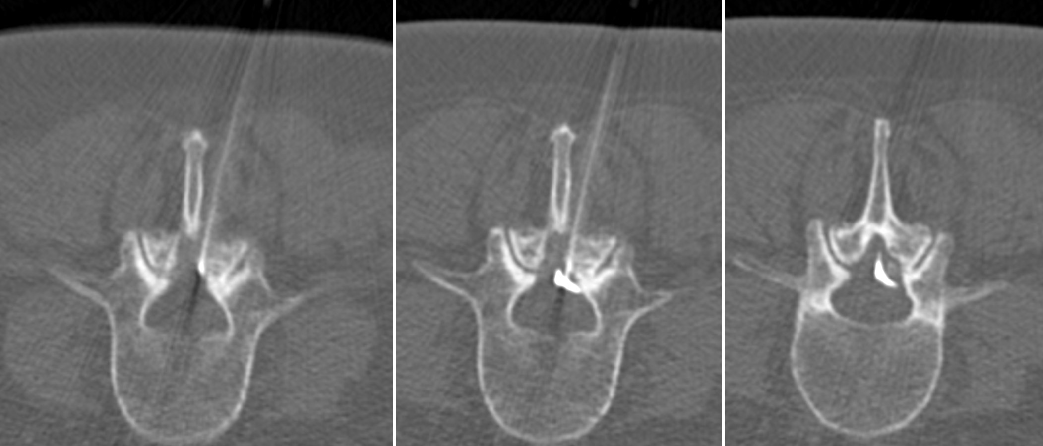 Infiltration épidurale – IMCSM