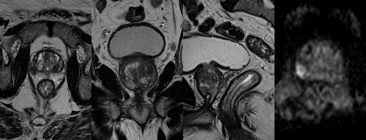 IRM prostatique – coupes d'imagerie de la prostate – IMCSM