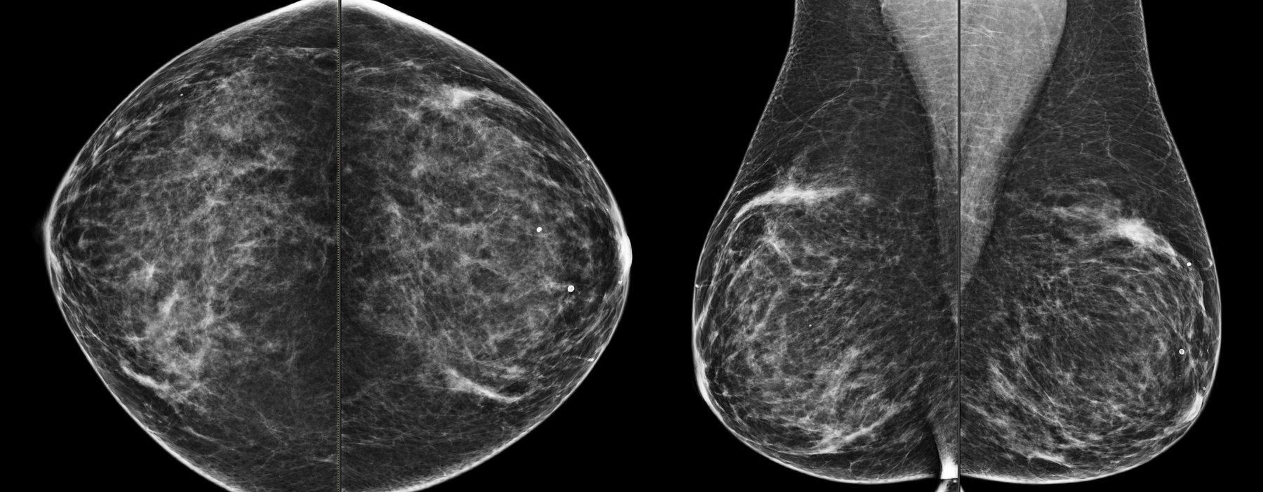 Mammographie – dépistage du cancer du sein – IMCSM